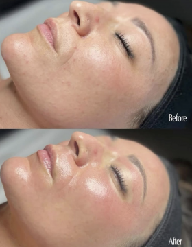 skin booster hounslow